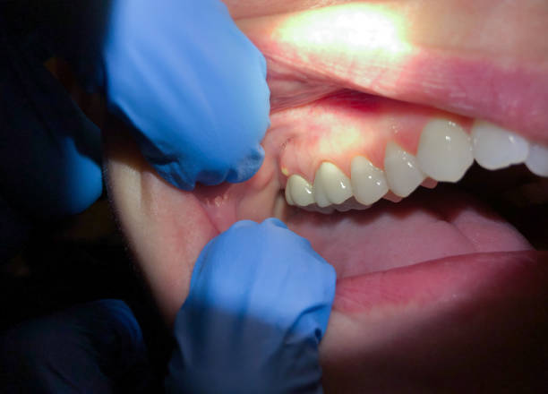 Best Lost Filling or Crown Replacement in Villas, FL